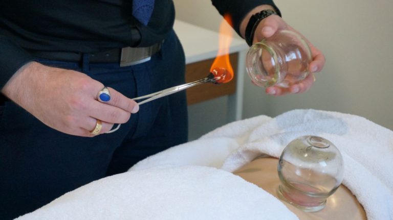 Cupping Therapy in Melbourne: Explore Its Healing Benefits