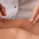 Acupuncture for Stress and Anxiety: A Complete Guide
