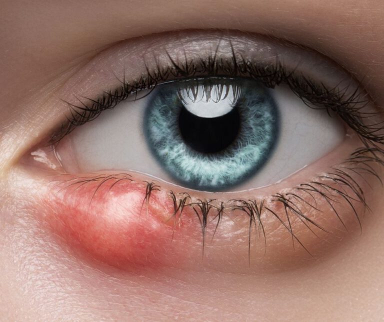 Eye Styes: Effective Home Remedies and Causes Explained